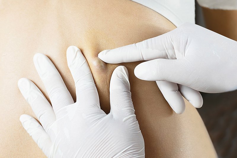 Cyst Removal:
A #cyst is one of the most common harmless #skintumors. They can be a nuisance, however as they can drain or become inflamed. 
Learn more about #CystRemoval at Acworth Dermatology: 
acworthderm.com/cyst-removal.h…