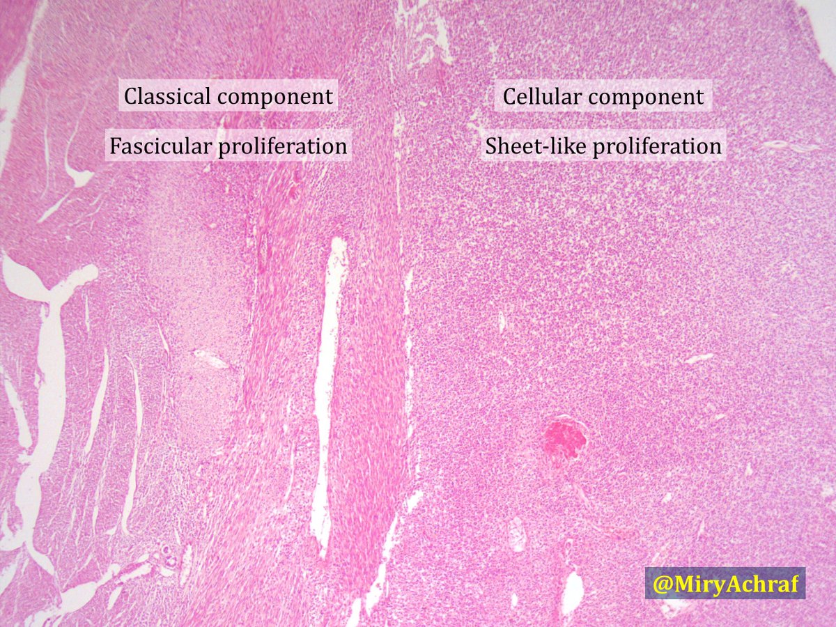 Achraf Miry On Twitter A Case Of Mixed Congenital Mesoblastic Nephroma In A 2 Months Old Infant First Described In 1967 Mixed Type Tumors Have A Combination Of The Classical And Cellular
