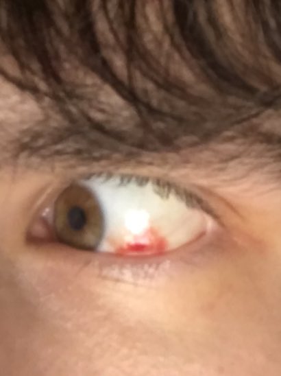 Dildoreilly's tweet photo. I’ve been told that I got this from @liamohLeary but u are wrong I actually got it from tugging myself to hard I jizzed in my own eye 💦 whoopsie daisy https://t.co/J1hbaORZxo