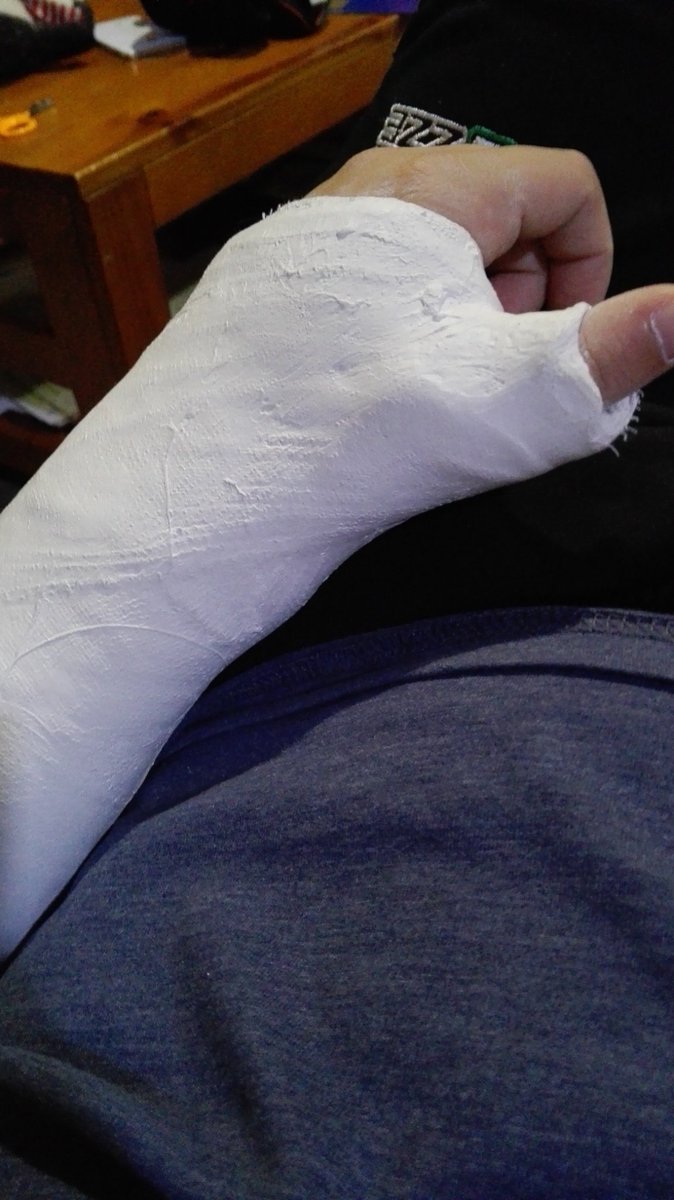 YoYMiBolsa's tweet photo. Lejos de mejorar, hoy me han comunicado que la muñeca que me fisuré hace tres semanas realmente estaba rota. https://t.co/nrEJSktFGn