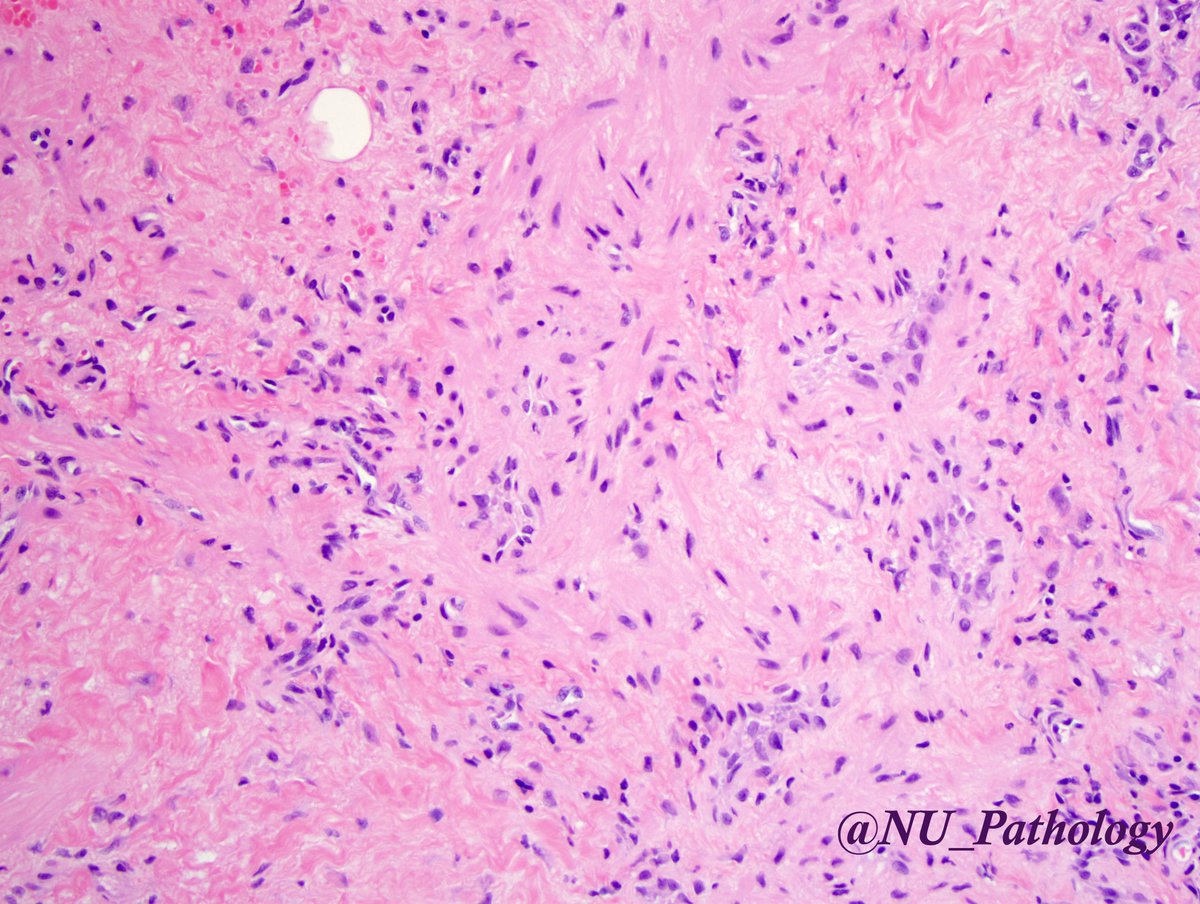 peritoneal mesothelioma ihc