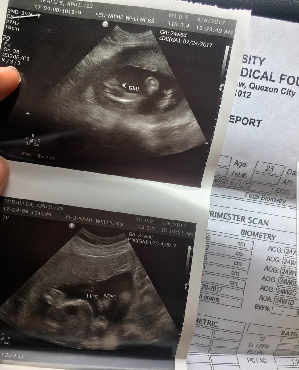aprilmvictoria's tweet photo. Atleast my ultrasound before was legit. 😉 #notfromgoogle #justsayin https://t.co/ZOPTPO6HvC