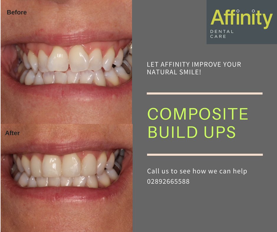 affinitydencare's tweet photo. 🤩🤩Transformation Tuesday!🤩🤩 
Non-Invasive Composite build ups..
Like what you see? 
👉Give us a call! 028 9266 5588
👉Learn more https://t.co/a8DJ5oVzve https://t.co/QTdcuIrC9e