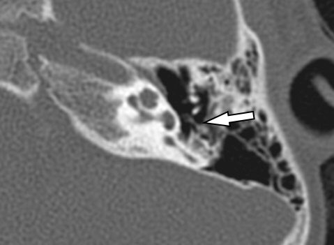 Tbone Tuesday. Toddler with congenital left CHL. Click  aspnr.org/diagnosis-tues… for dx, discussion, and more images. #pedineurorad #pedsrad #radres #meded #spine #MRI #FOAMRad #neuroradiology #Temporalbone @ASHNRSociety @TheASNR @SPRneuro