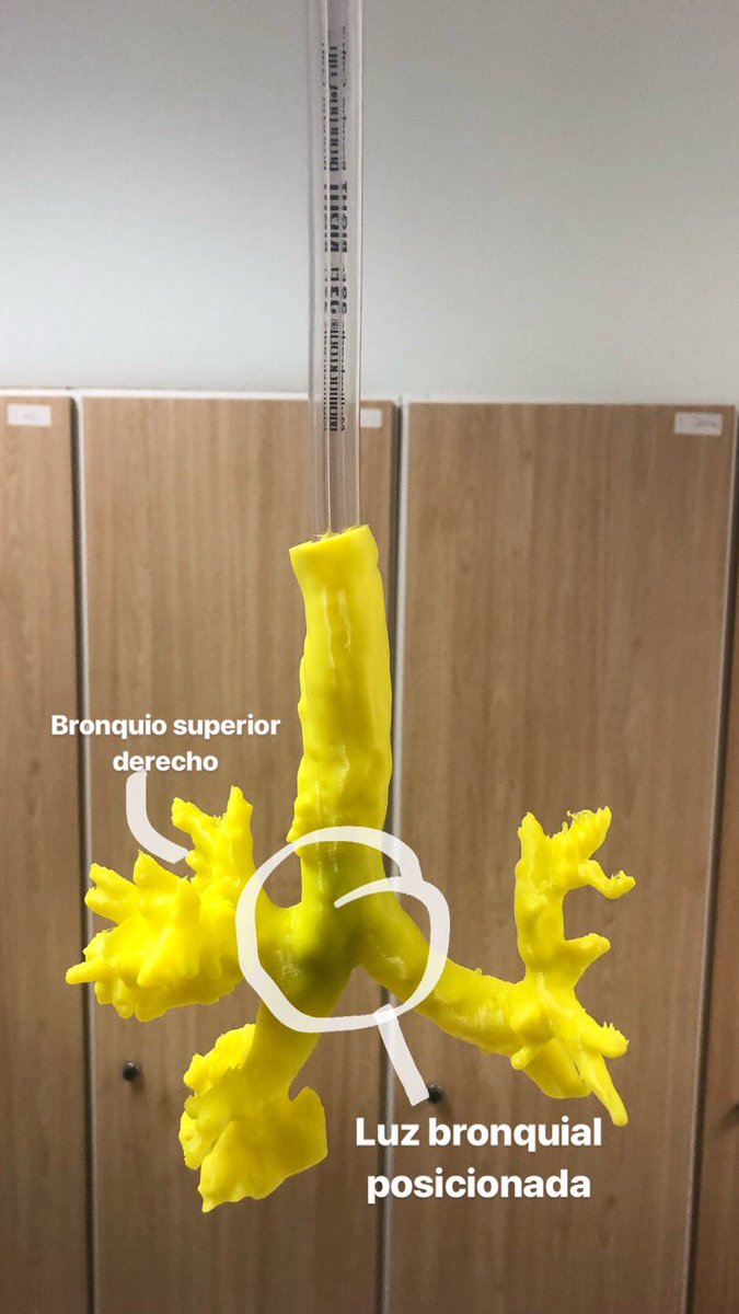 edusanpe's tweet photo. Double-lumen endotracheal placing planned with 3d printed airway #anesthesiology @3d_maranon #HospitalMaranon3D @BiomMarina @clararomerot @juan_merca2 @rupermac @calvoharo_ja https://t.co/wotR15SvxQ