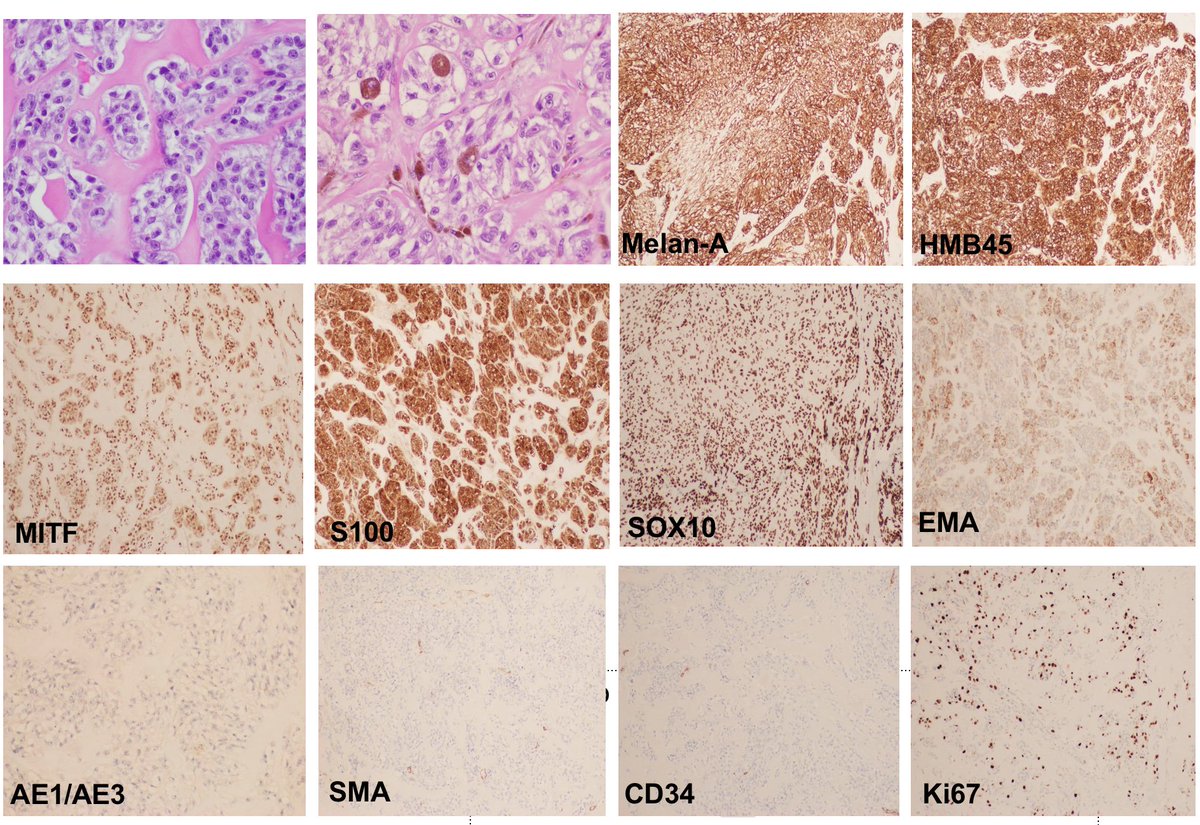 TexPathol's tweet photo. IHC in photos. FISH was + for EWSR1 rearrangement. Dx: Clear Cell Sarcoma. CSS is a translocation associated
sarcoma with melanocytic differentiation. LN mets often. Case courtesy Dr Lin Zhang. @lzhang003497248 #BSTpath #TSPchallenge @JaitlyVanya https://t.co/s0gOOdLFfq