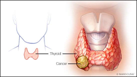 MayoClinic's tweet photo. Questions about treatment for #HurthleCell #ThyroidCancer? Dr. Keith Bible, an oncologist, replies in this #MayoClinicQandA. https://t.co/8IPxVWZJ8T https://t.co/3y9Yq64hZd