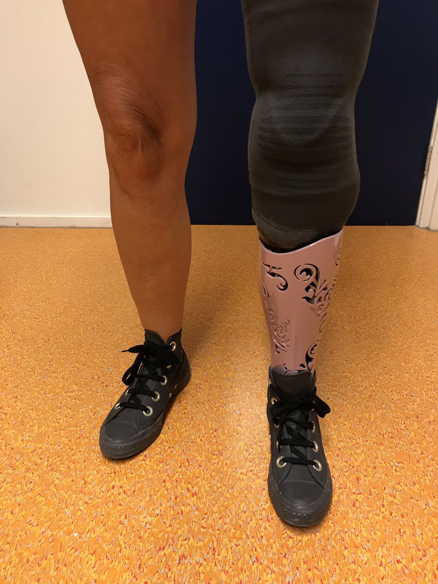 Vanmiddag cliënt blij gemaakt met een zelf gekozen design afwerking op haar onderbeen prothese <a href="/OIMOrthopedie/">OIM Orthopedie</a> <a href="/OIMZwolle/">OIMOrthopedie Zwolle</a>