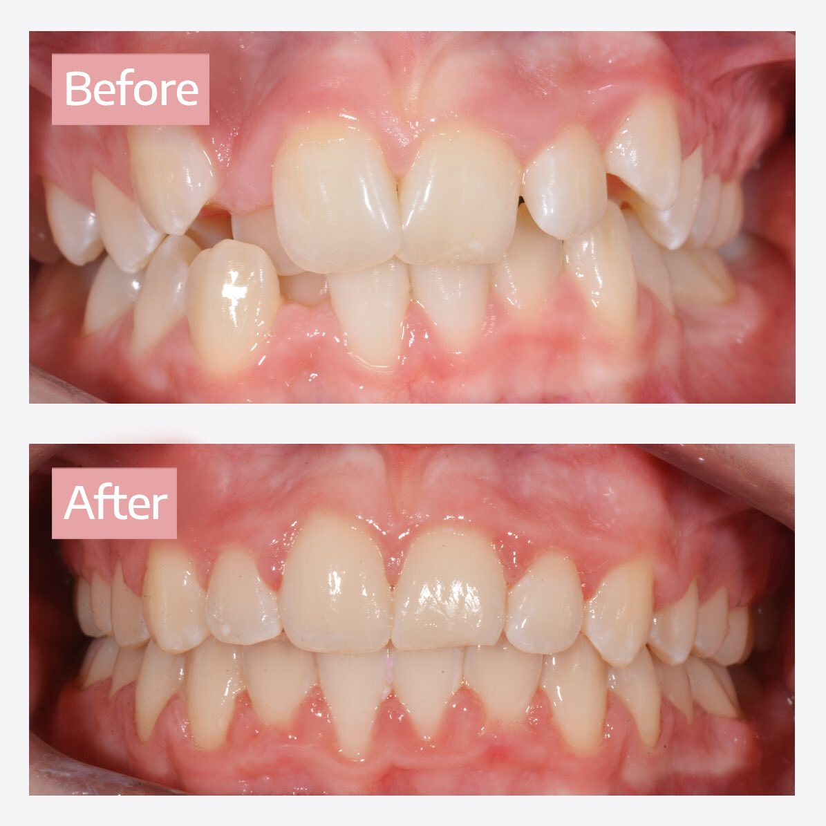 dsorthodontics's tweet photo. At #devonsquare #orthodontics, we pride ourselves in giving you the life long benefit of #confidence and improved #appearance. To find out what we can do for you, pop into our #practice for a chat or visit https://t.co/zppwwKcBwE for more information.
#smile #teeth #braces https://t.co/K3cYqbeNyg
