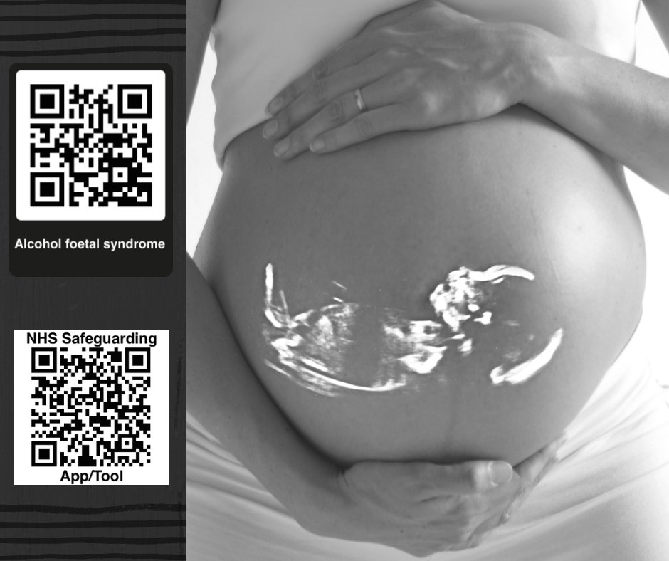 MAAPPUK's tweet photo. #Alcoholfoetalsyndrome
#MAAPPQuicklinks sharing partner agency resources promoting better outcomes for #ChildrenandFamilies #Maternity #Nurses #Health #SocialWorkers #Mums #Dads #Unbornbaby #Alcoholfoetalsyndrome
@kennygibsonnhs @nikki_ledingham
#NHSSafeguarding https://t.co/gq60ys56yw