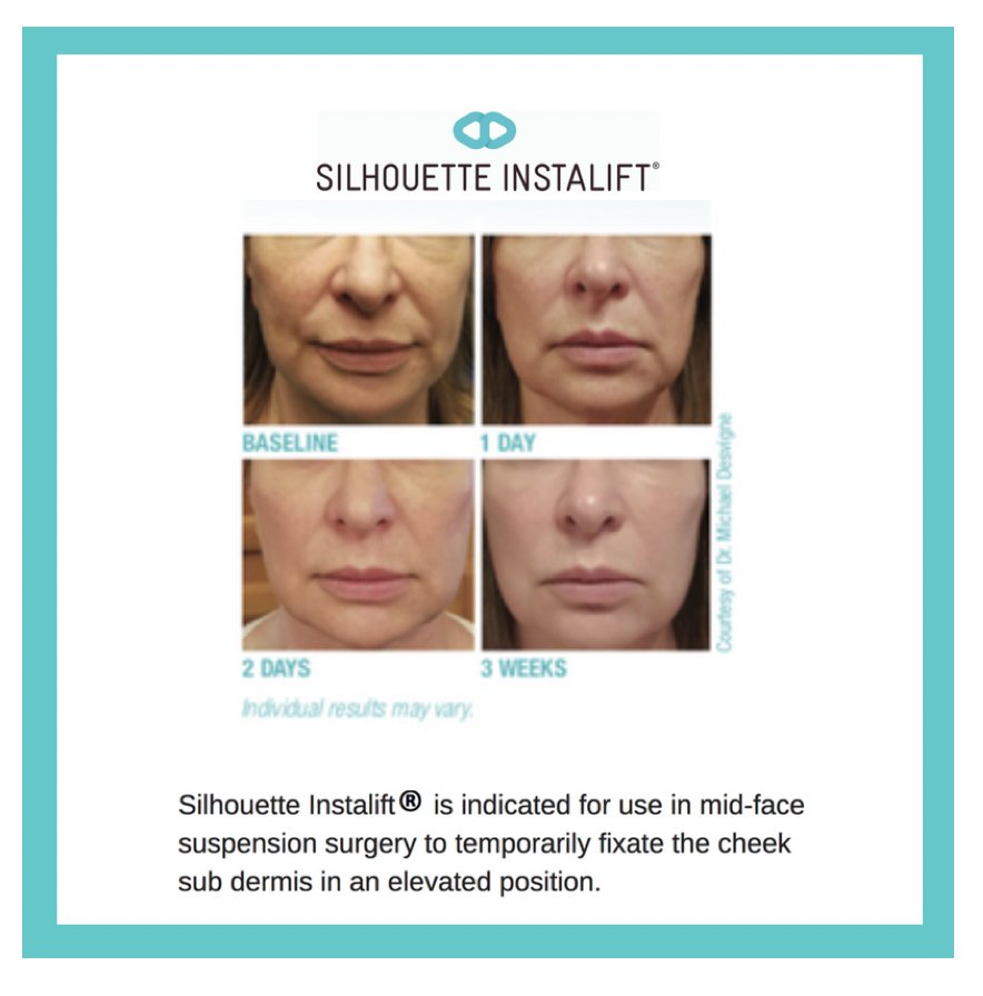 InstaliftUS's tweet photo. #SilhouetteInstalift is a unique, minimally invasive treatment that immediately redefines mid-facial contours for a natural, younger look. For more info, visit https://t.co/aBVlJKr7yS  Safety Info: https://t.co/GU6AmX5l6c https://t.co/kJH80JFxAM