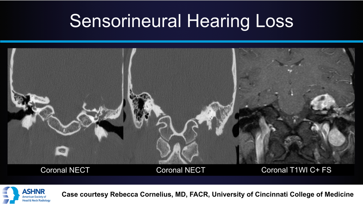 ASHNRSociety's tweet photo. #ASHNRCOTW #27: Sensorineural hearing loss. Diagnosis? Thanks Dr. @beccacornel for the case! #ASHNR19 

Answer in GIF, meme, or DM -- give everyone a chance to play along!

@DShatzkes @callyrobs @rhwiggins @CDP_Rad @nakoontz @cmtomblinson @LNLedbetter @JMcCartyMD @CMGlastonbury https://t.co/uu5TlU0sTf