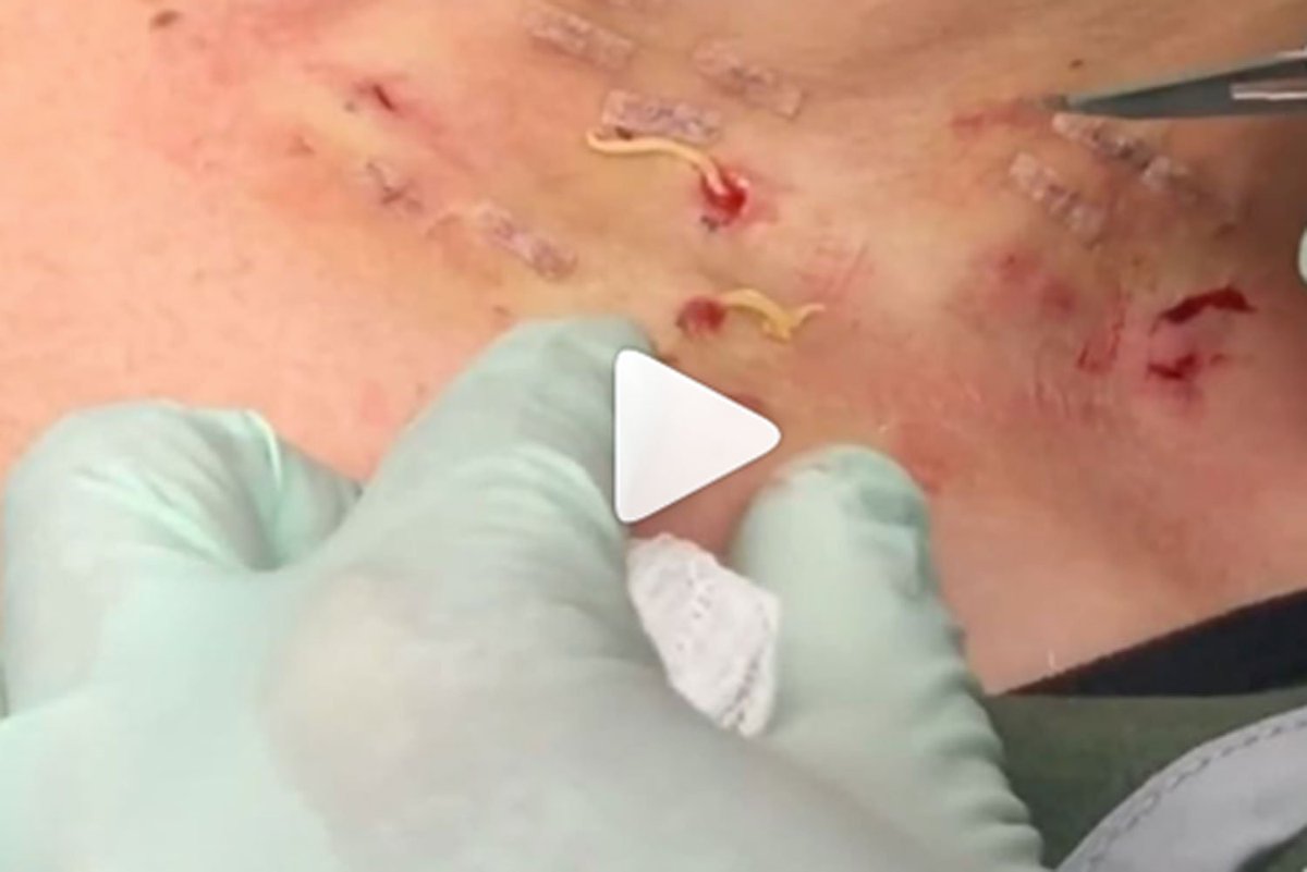 Pimple Popper Deutsch