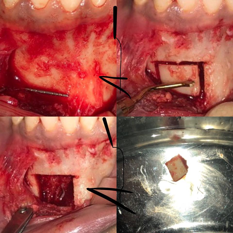 alldental18's tweet image. Learn the art of harvesting autogenous graft..😎
And many more basic and advance surgeries..!!🏆
watsapp-9873938121/9319146124
#alldental
#microsurgery
#piezosurgery
#diodelaser
#hardsofttissueaugmentations
#dentalcourses
#jkdentavision
#directsinuslift
#indirectsinuslift
