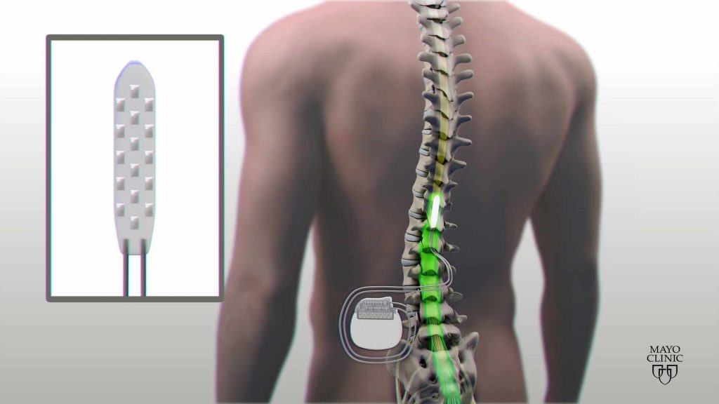 MayoClinic's tweet photo. Spinal cord stimulation and physical therapy have helped a man #paralyzed since 2013 regain his ability to stand and walk with assistance. The results of a Mayo Clinic and #UCLA collaboration are in @NatureMedicine.  https://t.co/Rw6OVf98UM https://t.co/l5MYaaPr3P