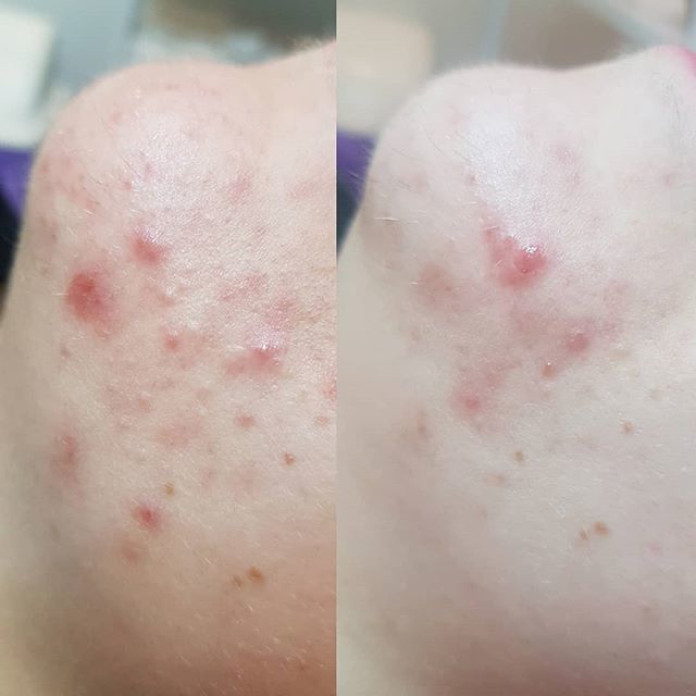 CharlieBeBeauty's tweet photo. Our client presented with adult acne.
These before and after photos show the results after three glycolic peels and an ASAP prescribed home skin care routine, half way through her treatments. #skinpeeling #skintherapist #skincare #skin #asapskinproducts … https://t.co/piiWHJH5Mu https://t.co/6TfYzDiDAd