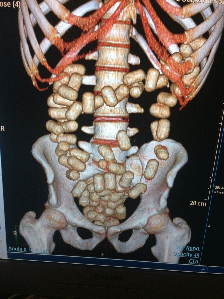 Medical Cases on Twitter "CT scan (3D reconstruction) of a drug mule