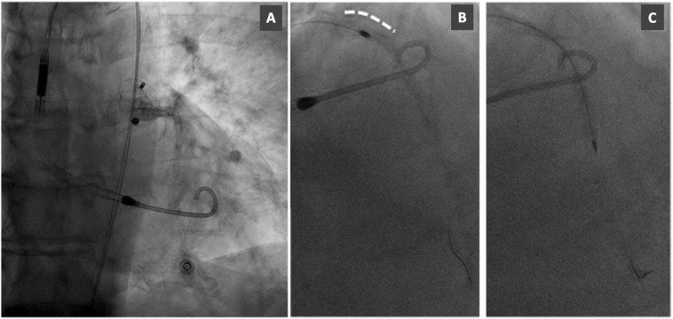 CRMjournal's tweet photo. Minimizing the risk of #contrastinducednephropathy and #hemodynamic collapse during #chronictotalocclusion #PCI with a #percutaneous #leftventricularassistdevice by @DamianoRegazzo1, Daisuke Hachinohe, @DrOzanDemir et al. in September issue https://t.co/Lfq2vtvJFQ https://t.co/4tF1Ikl5bD