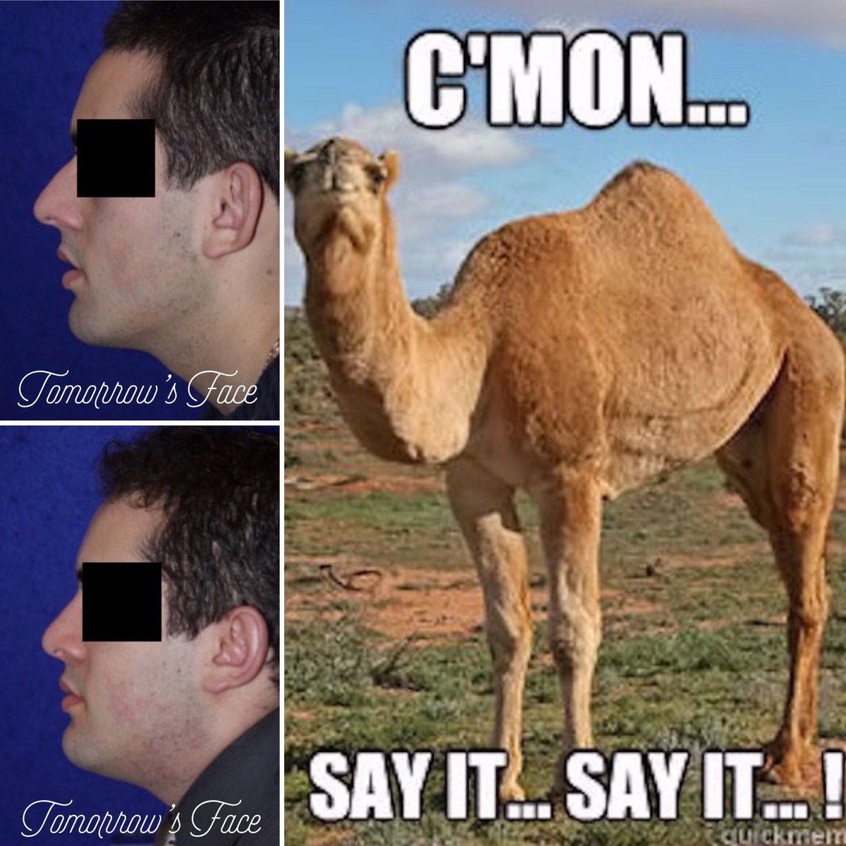 TomorrowsFace's tweet photo. Removing a #hump from the bridge of your #nose makes your nose become more #balanced with your #facialprofile. Are you a man who is considering a #Rhinoplasty? Learn more by visiting our website or call us today at: 973-243-1823!
https://t.co/jDnLJk19cI
πΈquikmeme https://t.co/uO70ZR4E0a