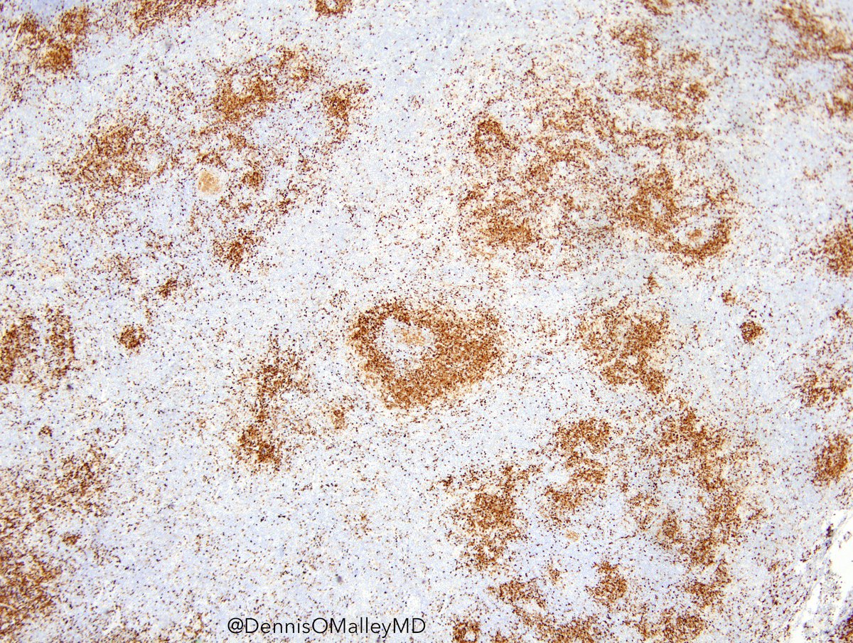 Dennis P O Malley Md This Is An Image Of A Tcl1 Ihc Stain In Lymph Node It Is Perhaps Best Used To Identify T Pll Or Plasmacytoid Dendritic Cells Or Blastic