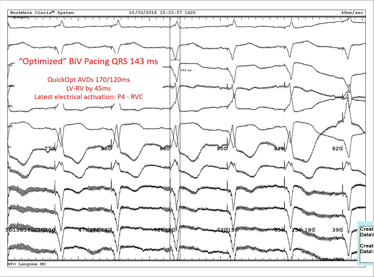 karametcalf_'s tweet photo. #SyncAV FTW! Baseline QRSd 167ms. "Optimized" w QuickOpt &amp; latest electrical activation for QRSd 143ms. With MPP &amp; SyncAV, a further reduction in QRSd to 114ms! 32% reduction from baseline &amp; 20% reduction from optimized! @NYULangoneEP @AbbottCardio https://t.co/9rkCZNFPT3 https://t.co/DwvugEUfOj