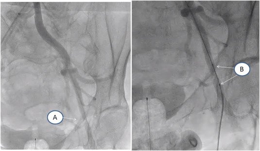 CRMjournal's tweet image. #Arteriotomy site complication during #transcatheteraorticvalvereplacement: #Ipsilateral wire protection and bailout by @edokaluski et al. in September issue bit.ly/2xV2lEo