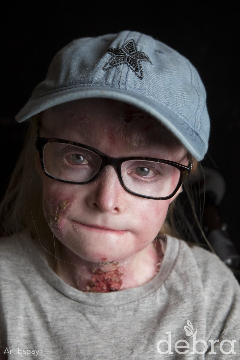debraOfAmerica's tweet photo. "Disabilities and hardships come in many different shapes and sizes; the thing about EB is that it is very visible…I get treated like I am a little kid even though I'm 21 years old." Read more + share Kourtney's #EverydayEB story in honor of #EBweek: https://t.co/LWiUU9NTEu https://t.co/8Xi9ATWkel