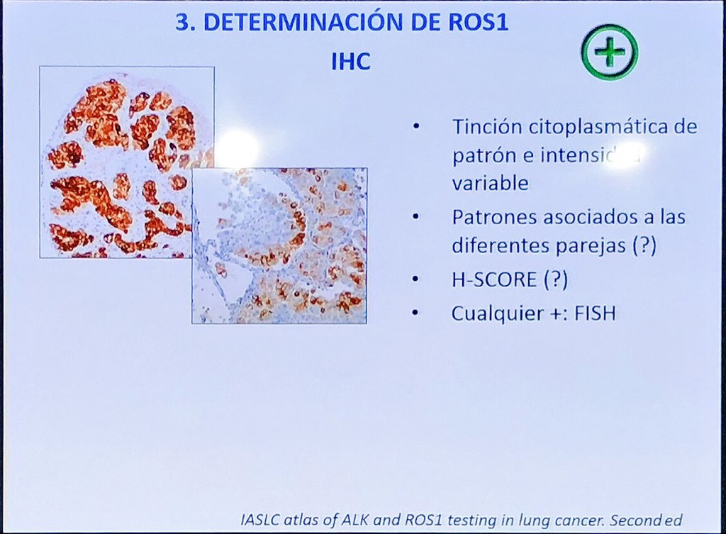 lara_pijuan's tweet image. .@SansanoValero como buena patóloga pulmonar nos explica trucos para mimar las biopsias tan pequeñas y valiosas 🙌🏻 Tips to make a plan and save tissue for molecular tests #ROS1 #CodingLungCancer #whypathologistmatter #pulmpath