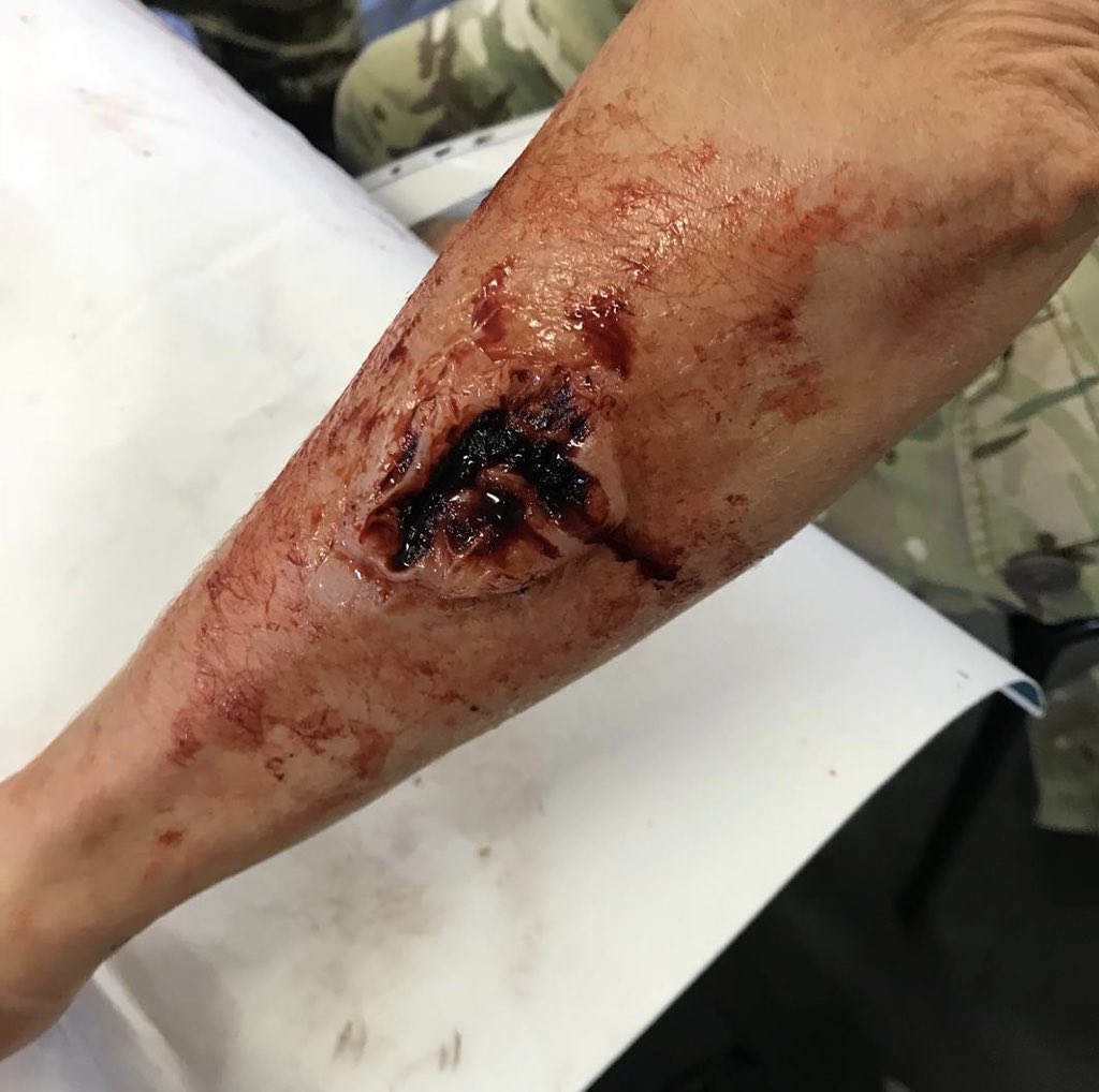 SIMBODIES's tweet photo. Trauma FX team have recently worked with @DMS_MilMed to provide realistic simulated injuries on our 100 + casualty role-players to assist #Medics from Norway, Estonia and the UK train together in a simulated field hospital as part of #exCJAS18.  #simulation #moulage https://t.co/drfBWyAENM
