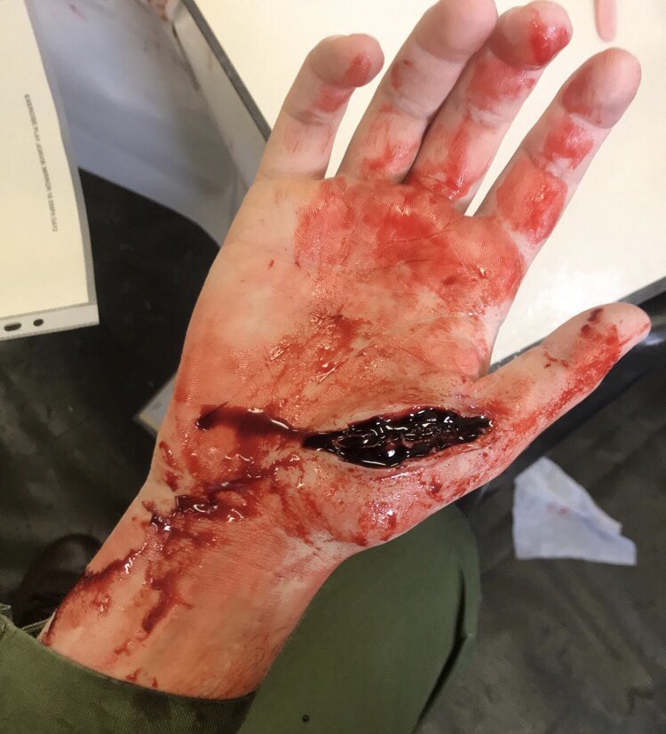 SIMBODIES's tweet photo. Trauma FX team have recently worked with @DMS_MilMed to provide realistic simulated injuries on our 100 + casualty role-players to assist #Medics from Norway, Estonia and the UK train together in a simulated field hospital as part of #exCJAS18.  #simulation #moulage https://t.co/drfBWyAENM