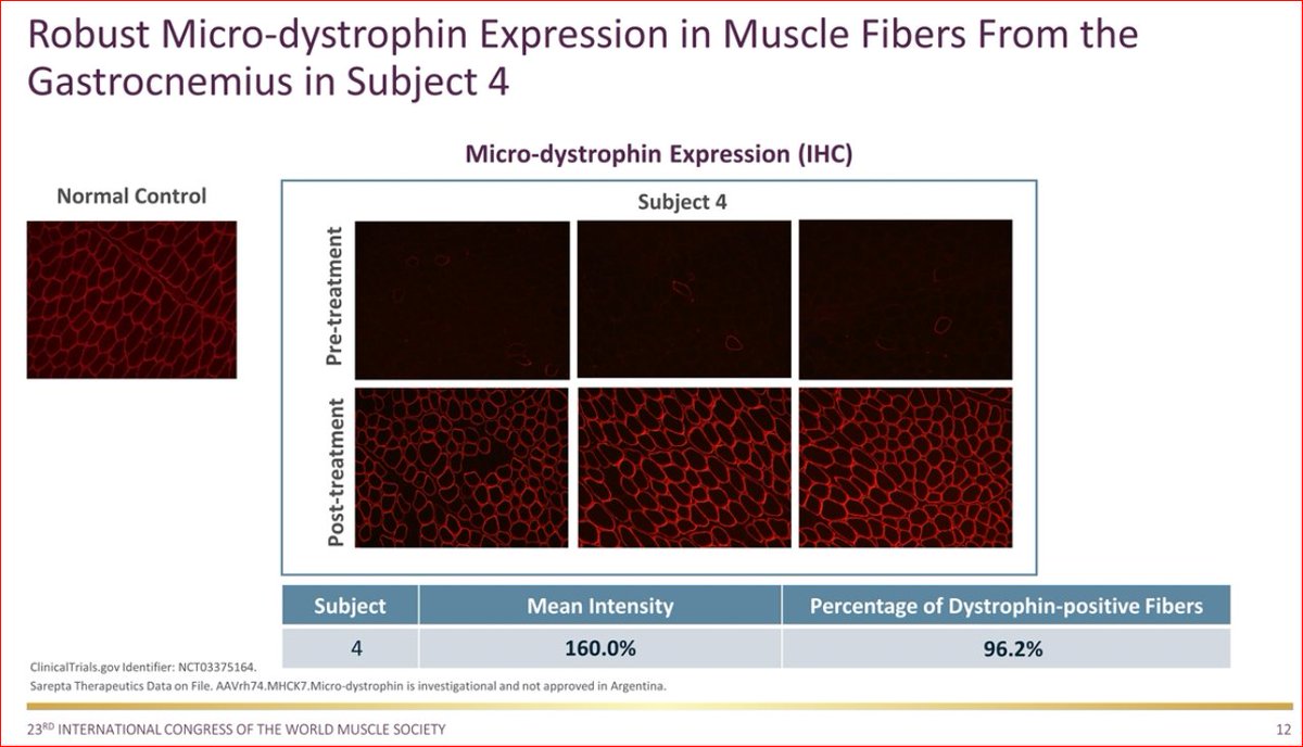Gantosj's tweet photo. $SRPT just look at the tissue in the 4th patient biopsy, looks like a normal muscle fiber!!! Nothing to add to this picture, worth 1000 words https://t.co/uLVeXjng4k
