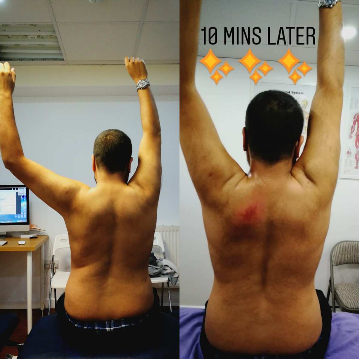 Working some magic on #shoulderimpingment see more of what we do on our Instagram stories @icaht_clinic