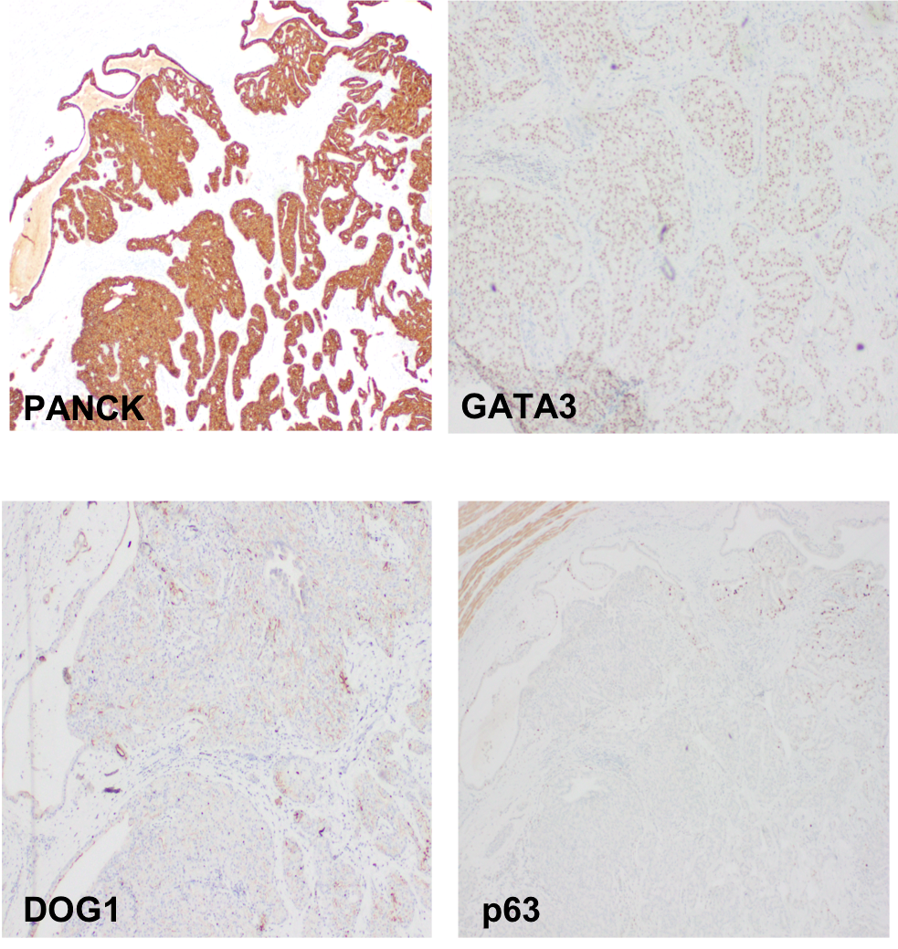 TexPathol's tweet photo. ETV6-NTRK3 gene rearrangement + by FISH. Dx: Secretory Carcinoma - defined by t(12;15)(p13;q25). Ddx on morphology
includes acinic cell carcinoma. Characteristically S100 +, Mammoglobin + and DOG1 -.
Case courtesy Dr. Jeffrey Conyers. #HeadNeckpath #TSPchallenge @JaitlyVanya https://t.co/0Ycd6JC2hx