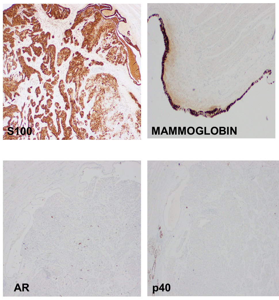 TexPathol's tweet photo. ETV6-NTRK3 gene rearrangement + by FISH. Dx: Secretory Carcinoma - defined by t(12;15)(p13;q25). Ddx on morphology
includes acinic cell carcinoma. Characteristically S100 +, Mammoglobin + and DOG1 -.
Case courtesy Dr. Jeffrey Conyers. #HeadNeckpath #TSPchallenge @JaitlyVanya https://t.co/0Ycd6JC2hx