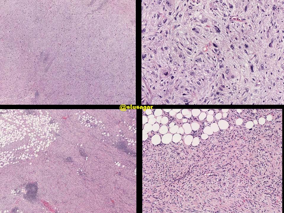 slusagar's tweet photo. #GUpath puzzler time!
adult human, radical nephrectomy performed for renal mass

🤔Dx? 🔬 https://t.co/QuVSg03OrH