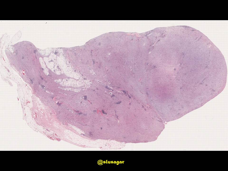 slusagar's tweet photo. #GUpath puzzler time!
adult human, radical nephrectomy performed for renal mass

🤔Dx? 🔬 https://t.co/QuVSg03OrH