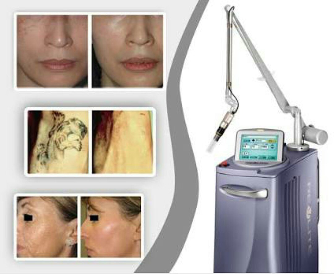 TanpreetBajaj's tweet photo. #Cynosure #Conbio #Revlite #QSwitched #NdYaGlaser #multiwavelength #goldstandard #nonAblative #skin #resurfacing #wrinkle #acne #scarReduction #antiaging #dermatologist #dermatology #cosmetology #cosmetologist #aesthetican https://t.co/aTRAcnZwiK
