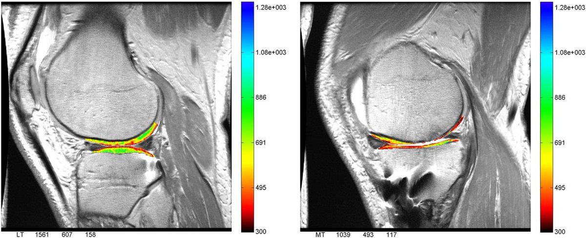 J_ISAKOS's tweet photo. does bone bruise affect #ACLR outcomes? https://t.co/6loWEJF4S4 https://t.co/Udouefpd2E