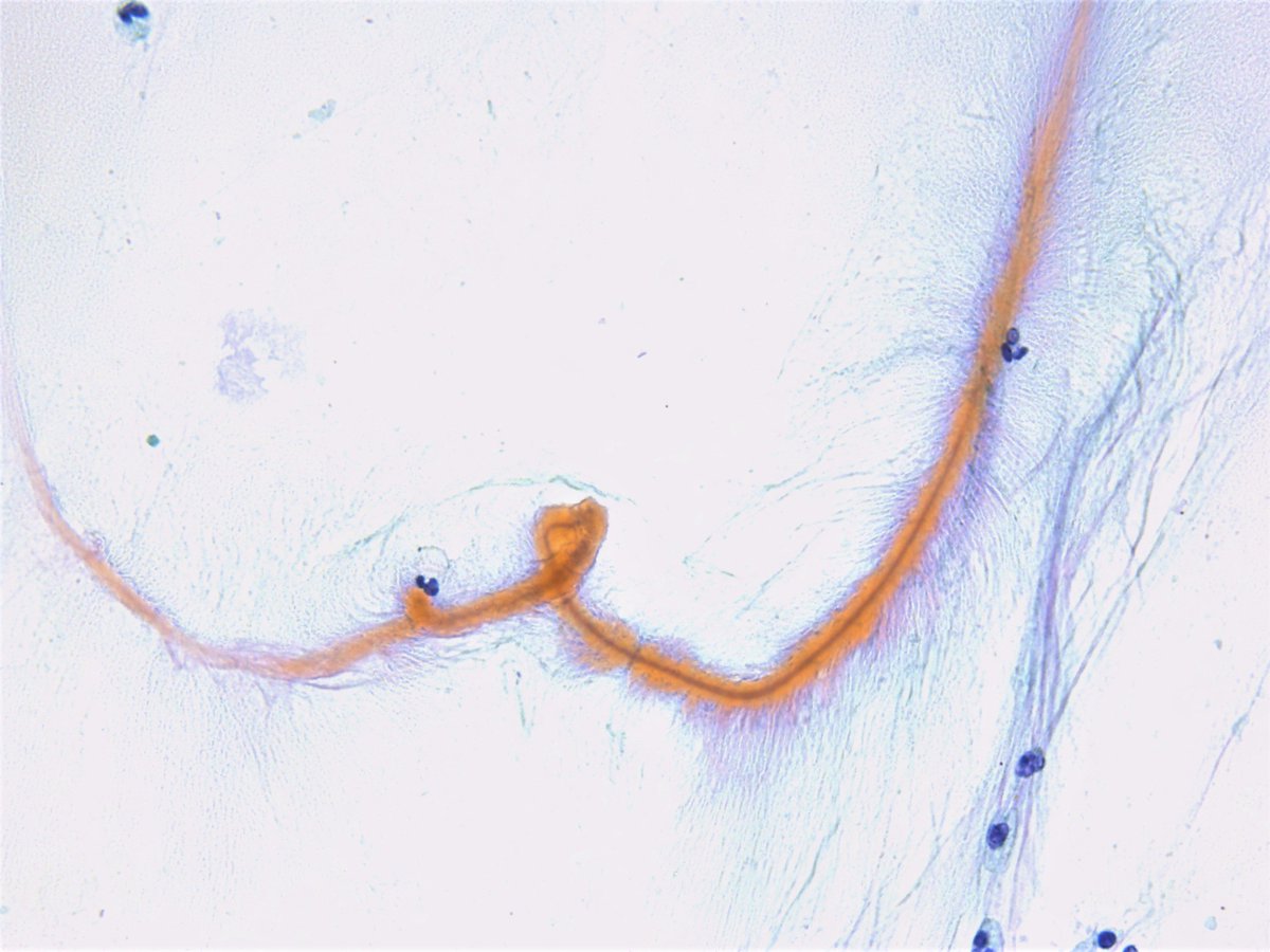 Patholwalker's tweet photo. Bushy Curschmann's spiral. Sputum, cytology. #pathology #Cytopath #Pulmopath https://t.co/aMnC9YBaS9