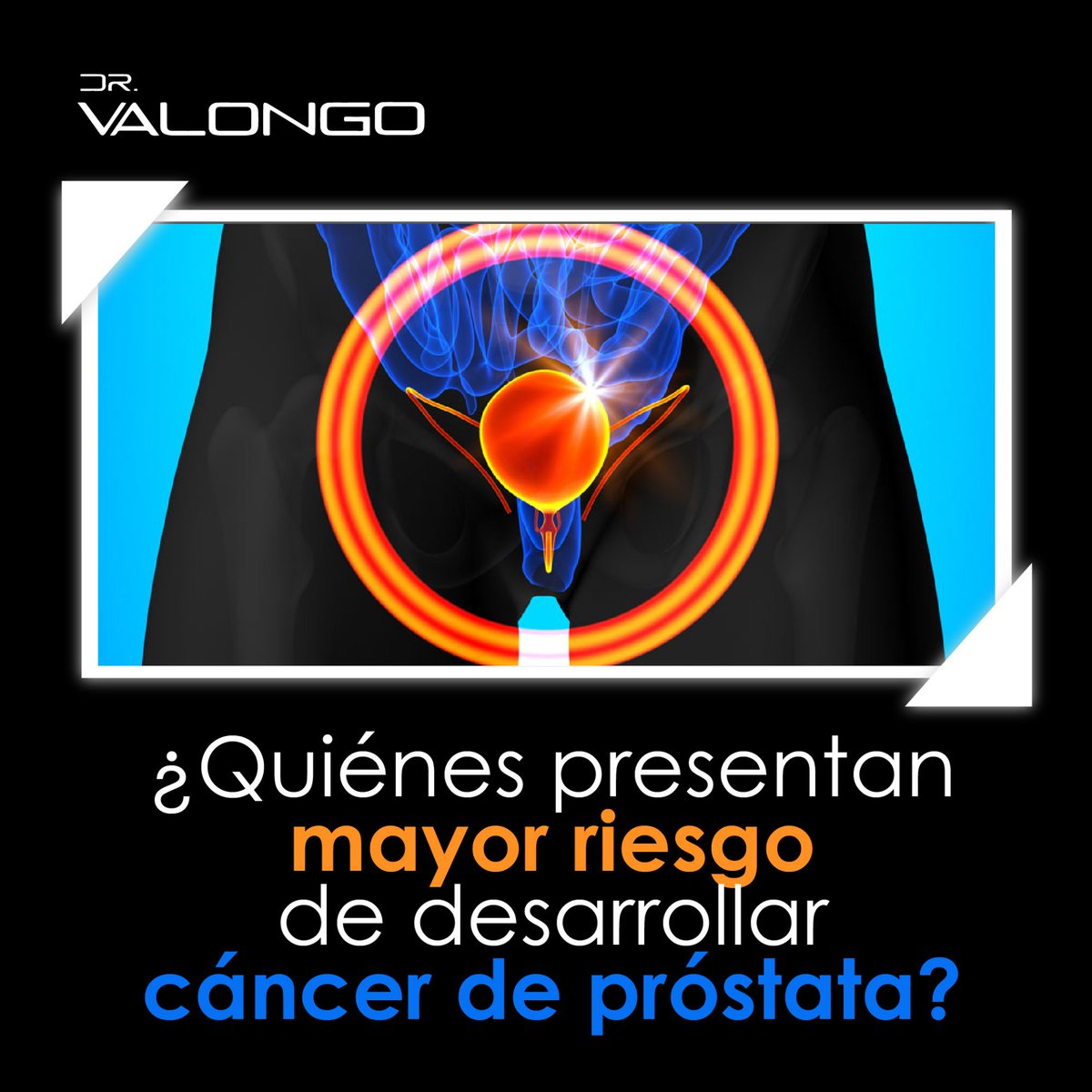 ¿Sabías que los hombres de piel oscura presentan mayor probabilidad de desarrollar cáncer de próstata que los de tez blanca? Conoce otros factores de riesgo: instagram.com/p/BmzOWyTgzl5/…