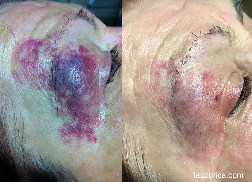 Lauzurica_Derma's tweet photo. Solo 4 sesiones con Luz Pulsada y ya vemos gran mejoría en esta Mancha en vino de Oporto de adulto.
#NordlysbyEllipse #IPL #dermatología #láser https://t.co/uw3kMUL3XJ