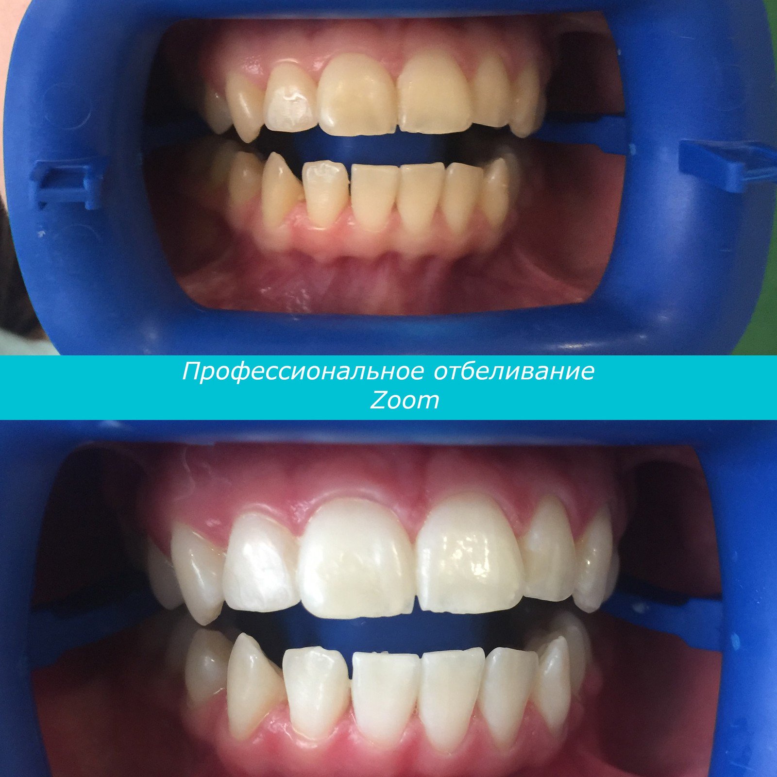 Методы отбеливание зубов отзывы curaprox 1450