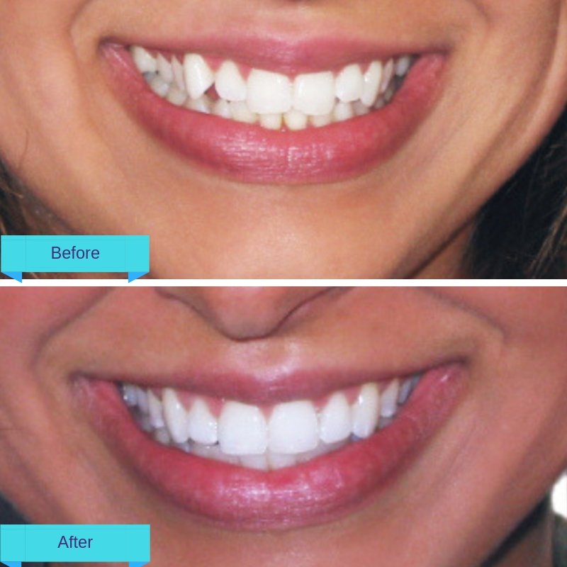 Six Month Smiles is a comprehensive orthodontic treatment, which can straighten all your teeth. And the best thing is, it takes just 6 months to complete and portrays speedy results.
#dentistry #dentistnearme #dentist #cypress #6monthsmile