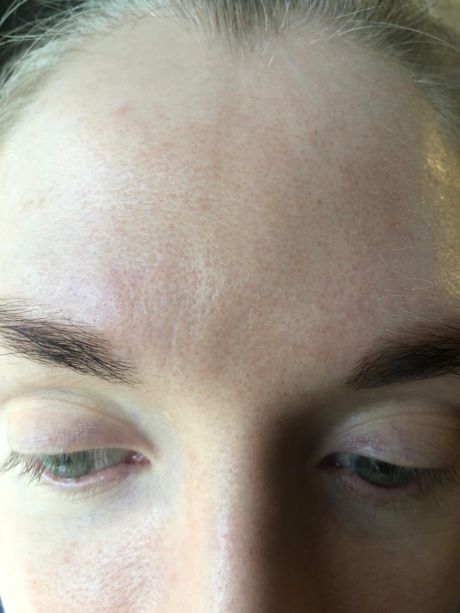 wrinkle between eyebrows cream