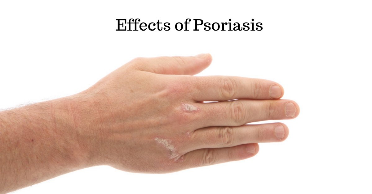 dynamichomeopat's tweet photo. Effects of Psoriasis :- https://t.co/XQXdO0pUQJ
#Effects of #Psoriasis https://t.co/HC4R0vzImu
