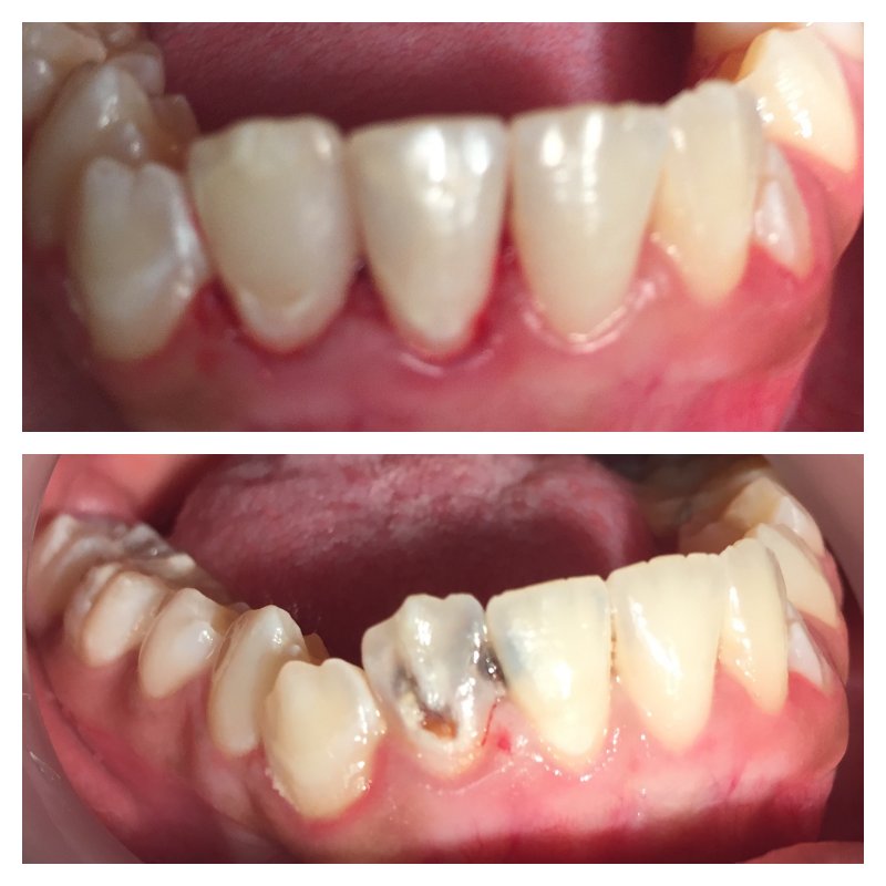 dentist_dibetso's tweet image. Tooth decay causes (bad breath) &amp;amp; PAIN! If left untreated the nerve/s &amp;amp; blood vessels inside the tooth will be damaged, leading to tooth abscess or tooth loss; compromises function (chewing) aesthetic, speech &amp;amp; more complications... #directcomposite #dentistry #visityourdentist