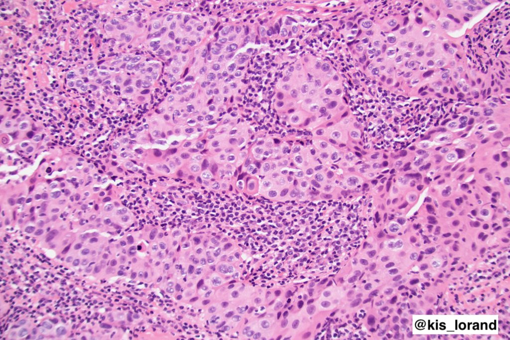 kis_lorand's tweet image. HER2-positive invasive breast carcinoma (NST). 
HER2 gene-protein assay: brightfield tricolor assay (combined ICH+ISH) for the visualization of  HER2 protein (brown), the HER2 gene (black), and chromosome 17 centromere (CEN17) (red).