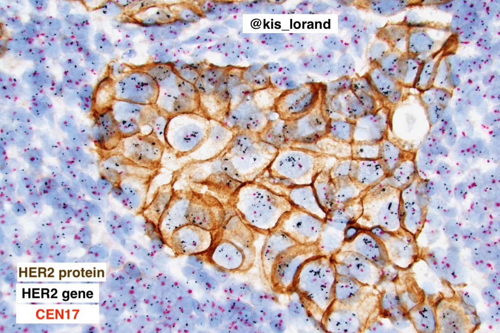 kis_lorand's tweet image. HER2-positive invasive breast carcinoma (NST). 
HER2 gene-protein assay: brightfield tricolor assay (combined ICH+ISH) for the visualization of  HER2 protein (brown), the HER2 gene (black), and chromosome 17 centromere (CEN17) (red).