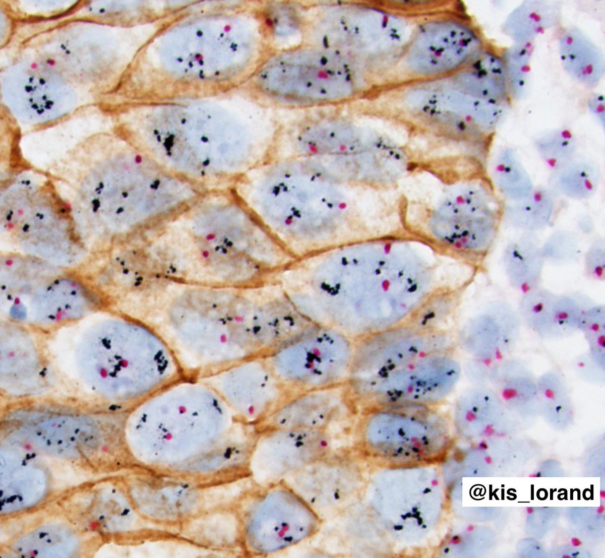 kis_lorand's tweet image. HER2-positive invasive breast carcinoma (NST). 
HER2 gene-protein assay: brightfield tricolor assay (combined ICH+ISH) for the visualization of  HER2 protein (brown), the HER2 gene (black), and chromosome 17 centromere (CEN17) (red).