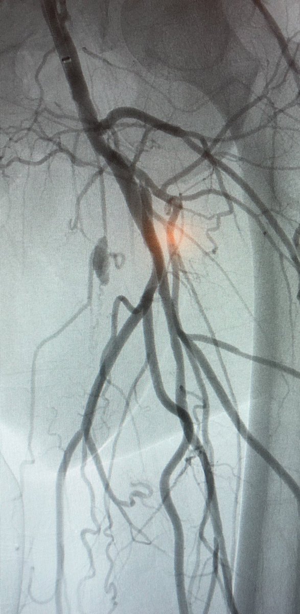 roblookstein's tweet photo. Live @MountSinaiIR #MountSinaiWest campus First #Eluvia DES implanted in USA post FDA approval. Thx to @bsc_pi for the support. #ThinkEluvia #Eluviafirst @SIRspecialists @SIRRFS @tctmd @EVToday @MountSinaiNYC https://t.co/Kw2gw4GEQs